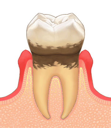 歯周病は知らないうちに歯ぐきの骨がなくなる恐ろしい病気です