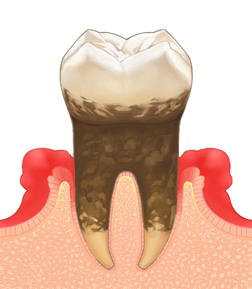 歯周病は知らないうちに歯ぐきの骨がなくなる恐ろしい病気です