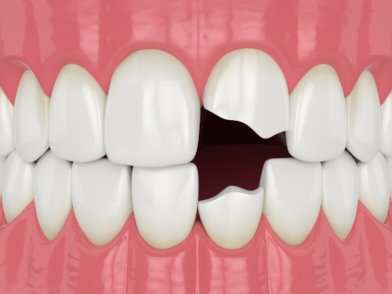 お口の中やその周囲の裂傷・歯の破折等の治療