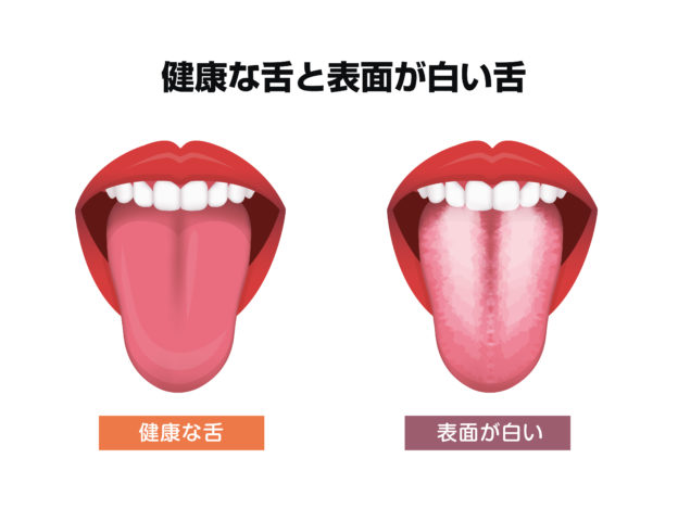 健康な舌の比較イラスト