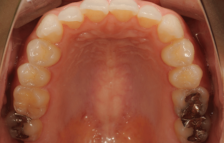 上の歯の奥歯のセラミック治療治療前