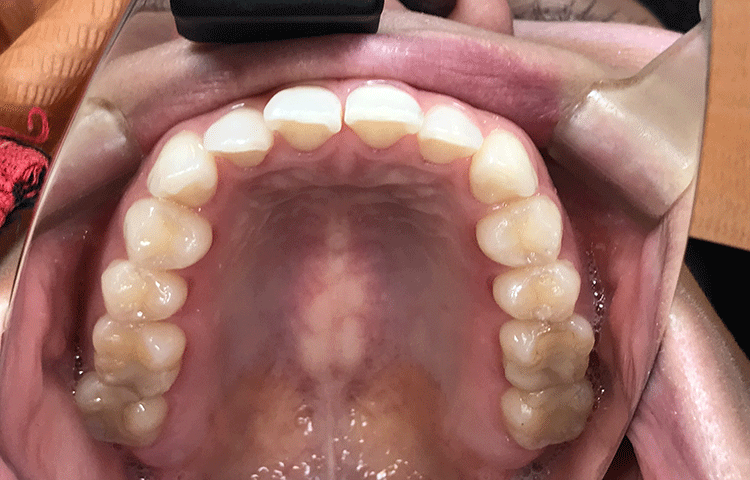 上の歯の奥歯のセラミック治療治療後