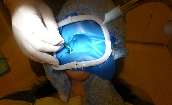 失敗しないセレック治療