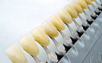 審美歯科の種類