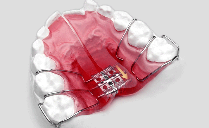 床矯正の装置は取り外しが可能です