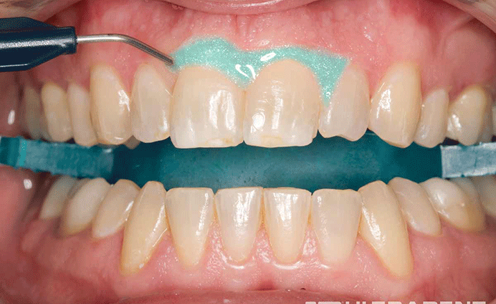 オフィスホワイトニング