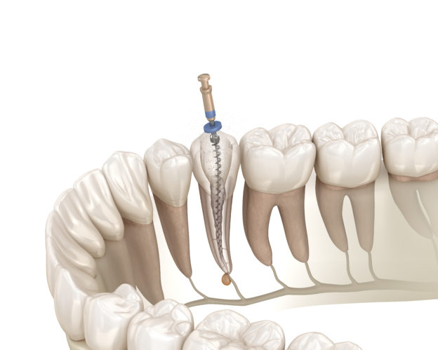 Endodontic root canal treatment process. Medically accurate toot