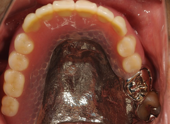 金属床部分入れ歯治療後
