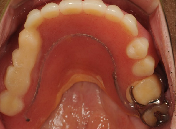 金属床部分入れ歯治療前