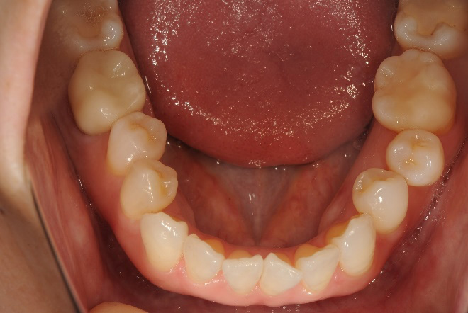 セレックインレー、セレッククラウン治療後