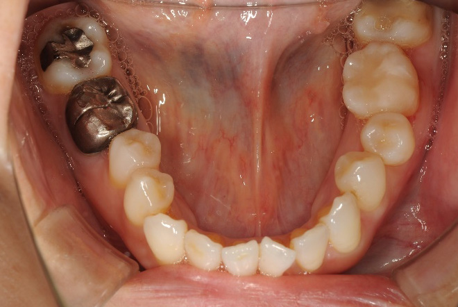 セレックインレー、セレッククラウン治療前