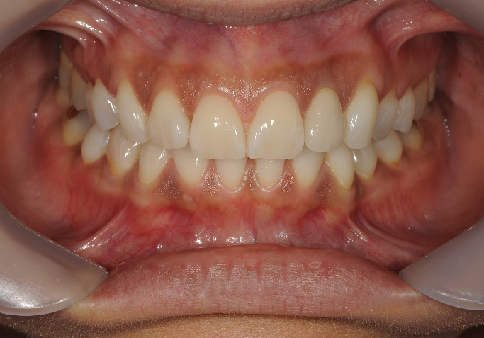 ラミネートべニア修復、ジルコニアセラミック修復治療後