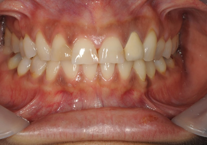 ラミネートべニア修復、ジルコニアセラミック修復治療前